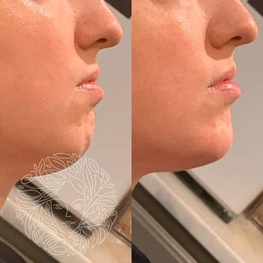 Dermal Fillers Gallery Before & After