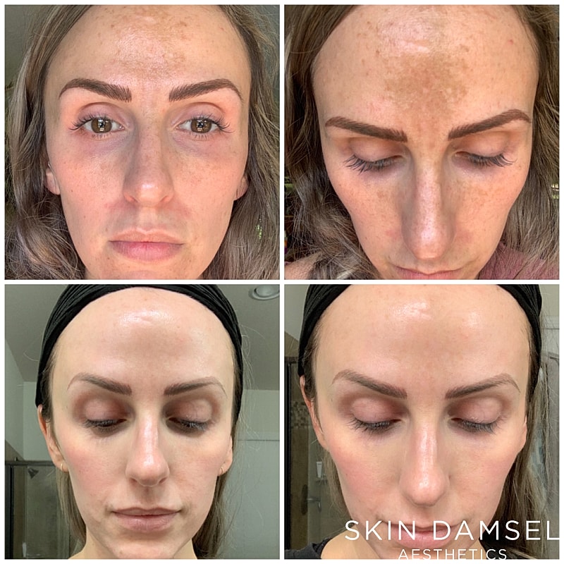 Chemical Peels Gallery Before & After