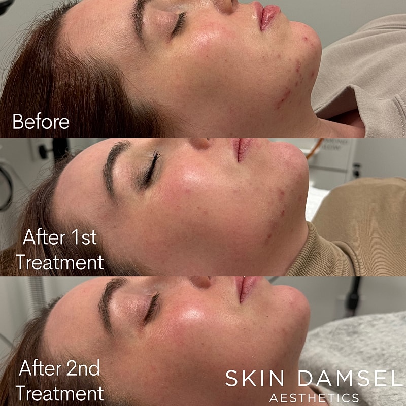 Chemical Peels Gallery Before & After