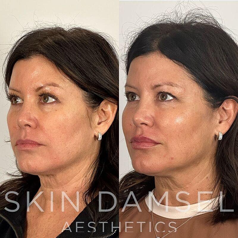 Bio Fillers Gallery Before & After