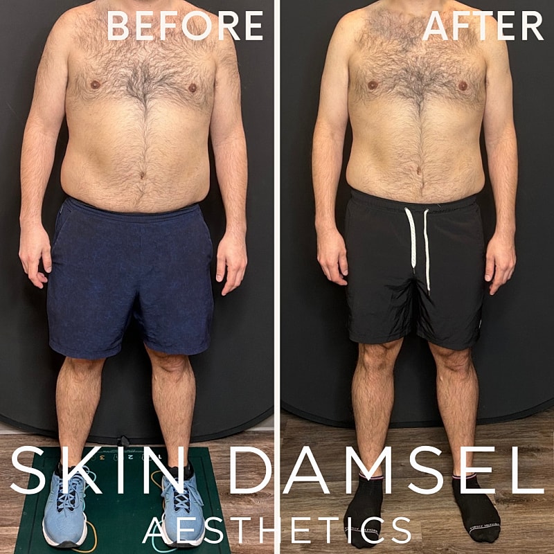 Semaglutide Gallery Before & After