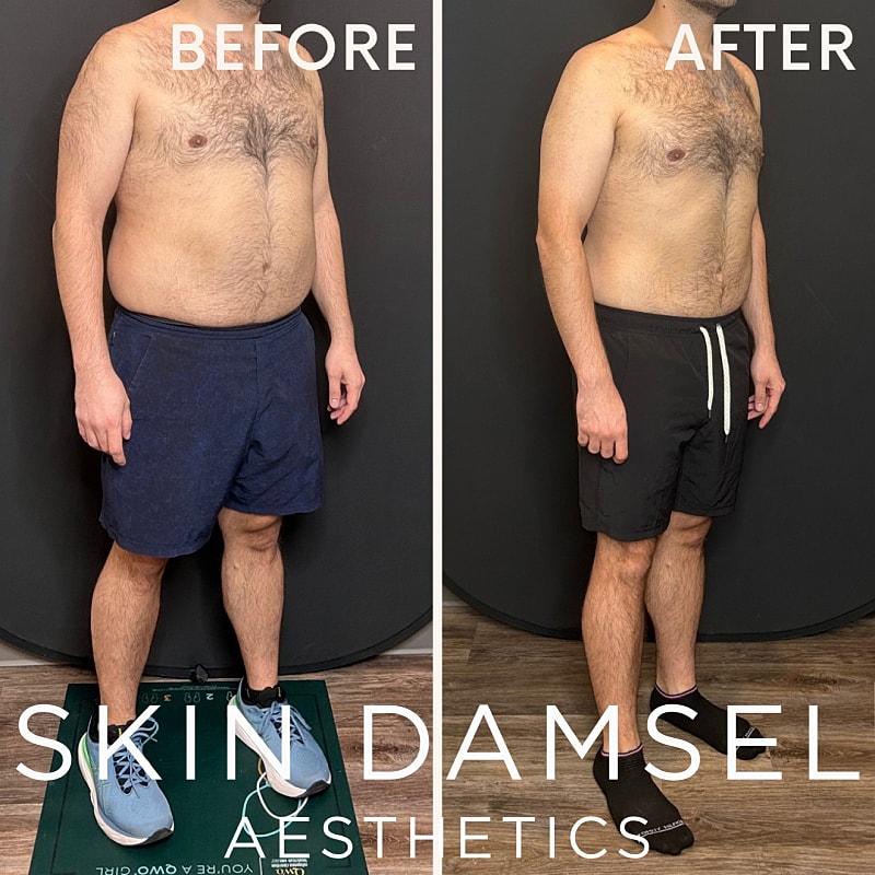 Semaglutide Gallery Before & After