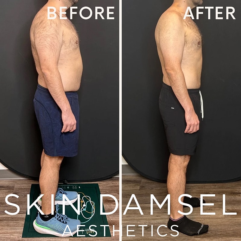 Semaglutide Gallery Before & After