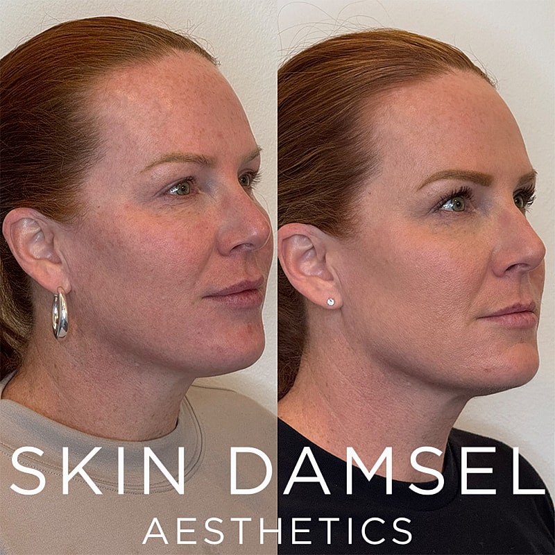 BBL Laser Gallery Before & After