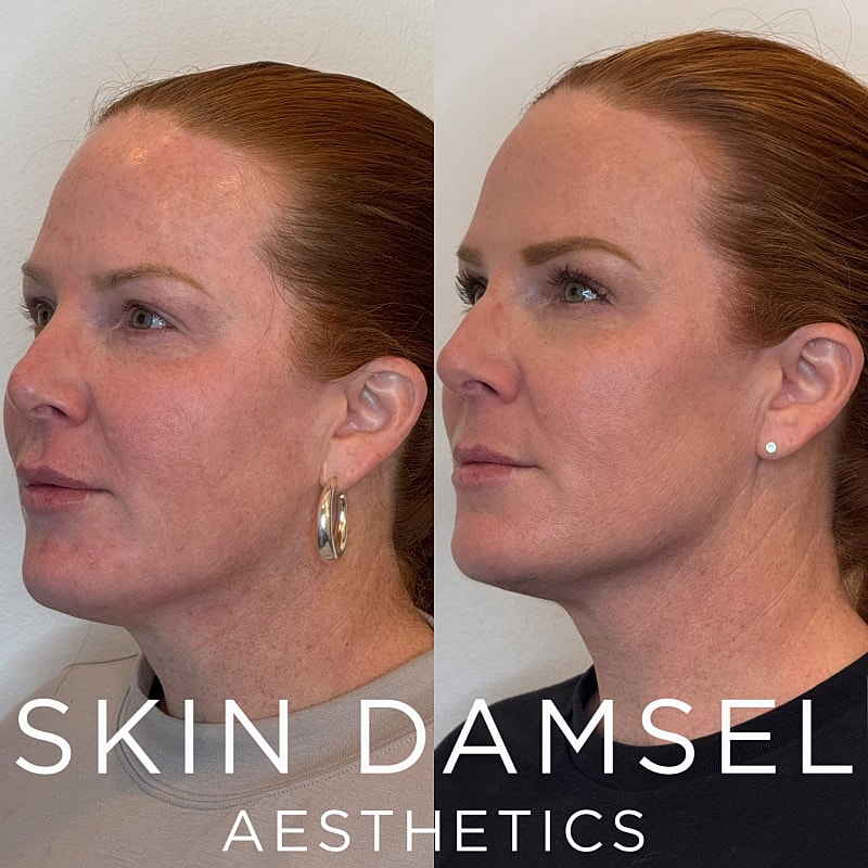 BBL Laser Gallery Before & After