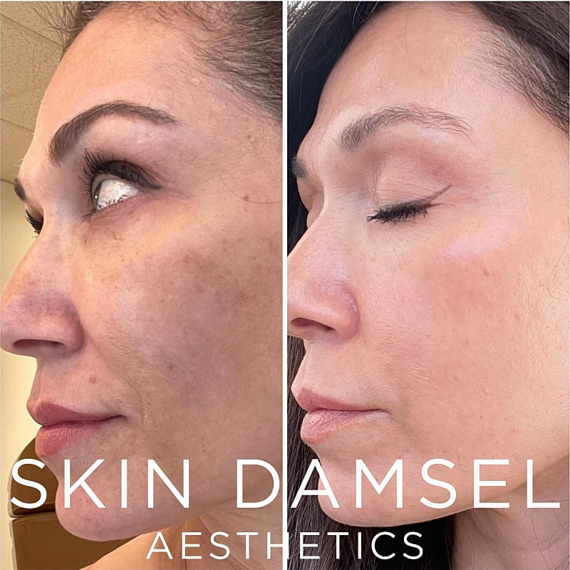 BBL Laser Gallery Before & After