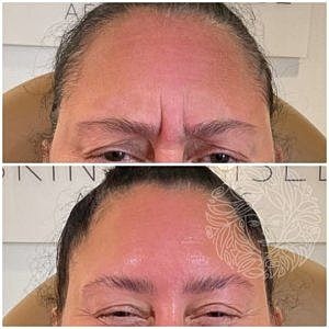 Dysport Gallery Before & After