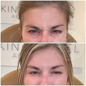 Dysport Gallery Before & After