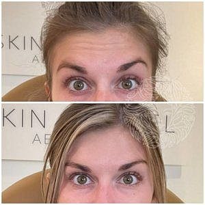 Dysport Gallery Before & After