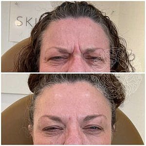 Dysport Gallery Before & After