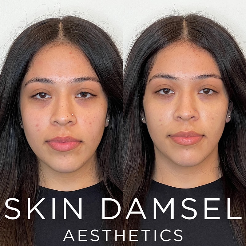 Tear Trough Filler Gallery Before & After