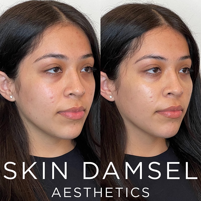 Tear Trough Filler Gallery Before & After