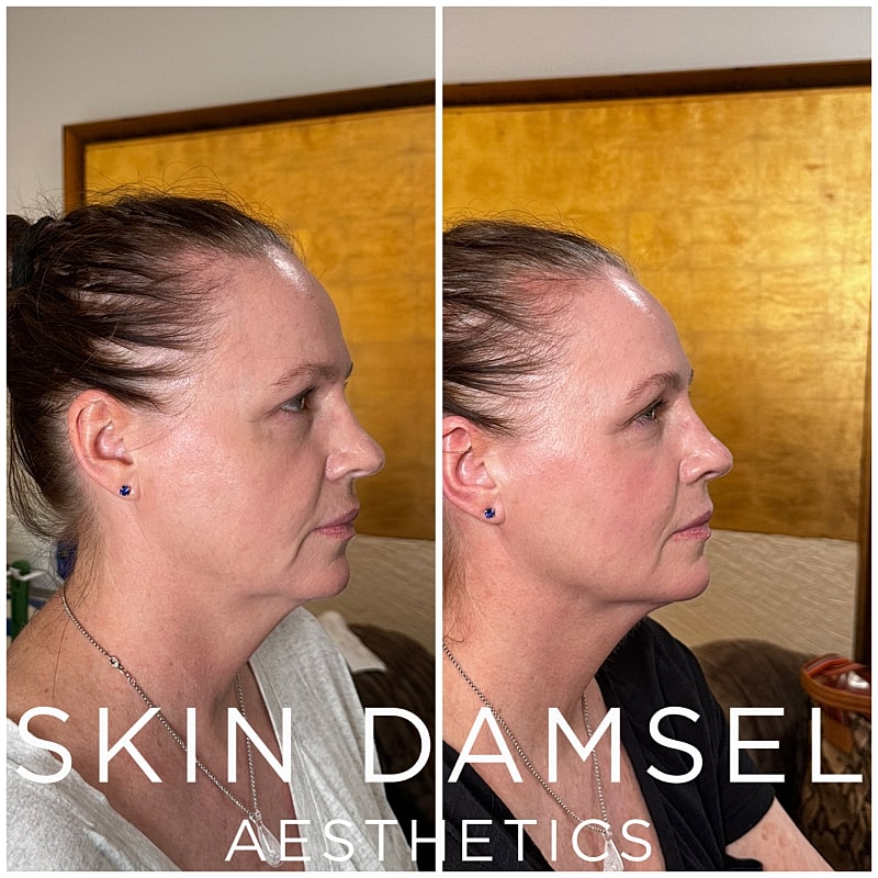 Neffrettiti Before & After