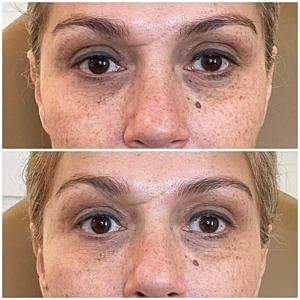 Upneeq Eye Drops Gallery Before & After