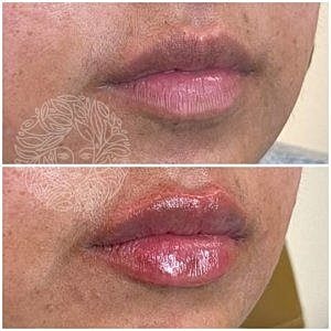 Lip Filler Gallery Before & After