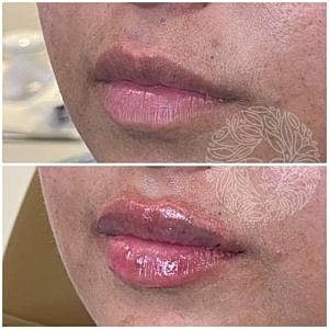 Lip Filler Gallery Before & After