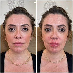 Lip Filler Gallery Before & After