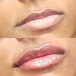 Lip Filler Gallery Before & After