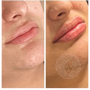 Lip Filler Gallery Before & After