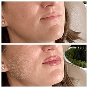 Lip Filler Gallery Before & After