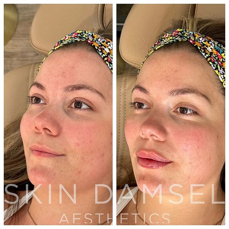 Lip Filler Gallery Before & After