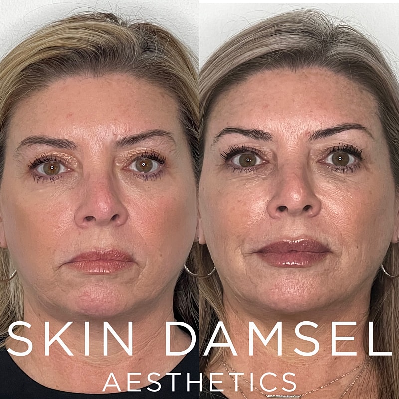 Facial Balancing Before & After