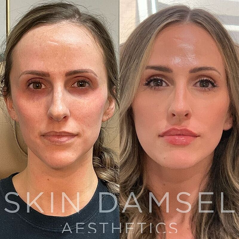 Facial Balancing Gallery Before & After