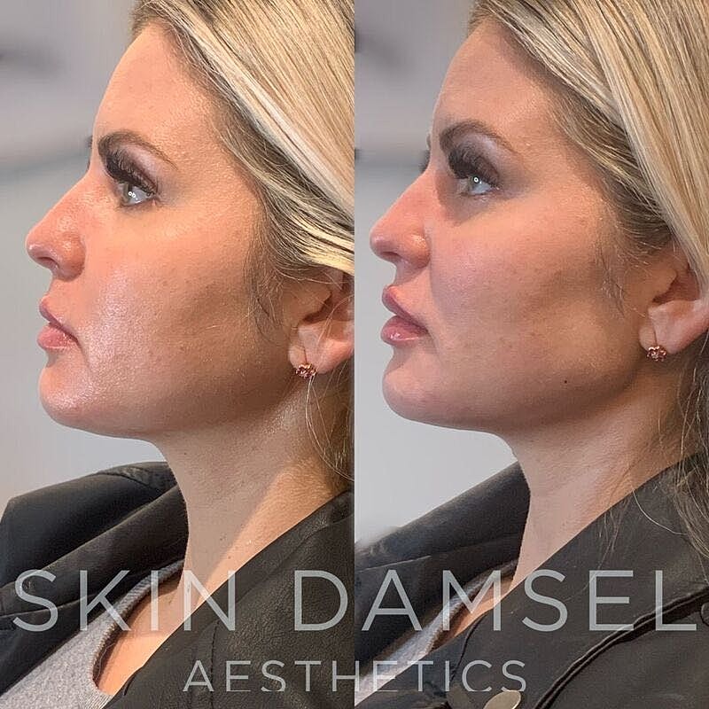 Facial Balancing Gallery Before & After