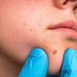 Woman in process of Skin Tag Removal