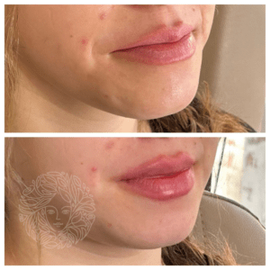 Lip Filler by Nurse Practitioner Jessi 4